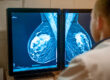Arzt betrachtet Mammografie-Bilder auf Monitoren